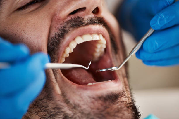 Best Emergency Wisdom Tooth Extraction in Chase, PA